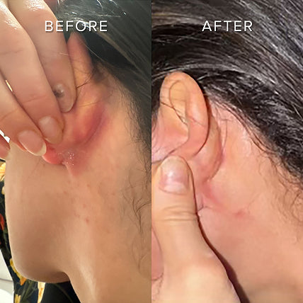 SOOTHES ECZEMA & IRRITATION