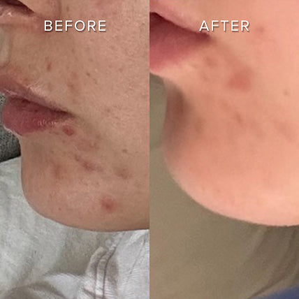 REDUCES INFLAMMATION & SCARRING